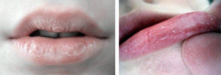 Покраснение в уголках губ: причины шелушения кожи и красноты - почему она шелушится и краснеет?