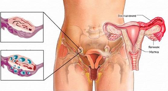 Свечи от воспаления яичников: вагинальные, ректальные