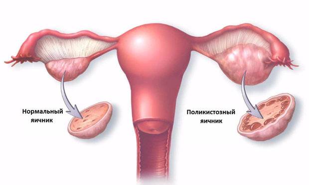 Возможна ли беременность при дисфункции яичников