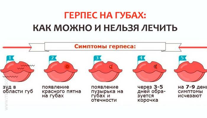 Герпес: лечение простуды на губах у ребенка. герпес генитальный и на губах