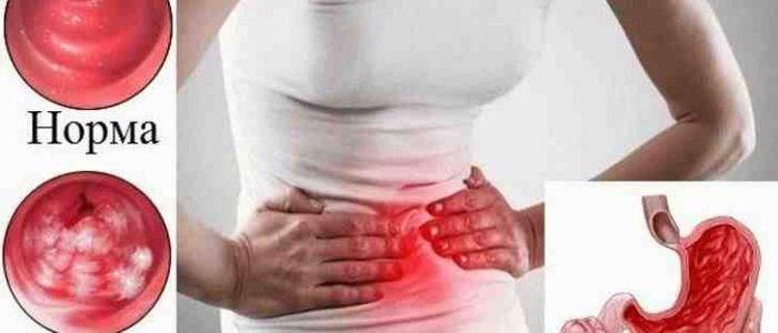 Симптомы гастрита желудка у женщин