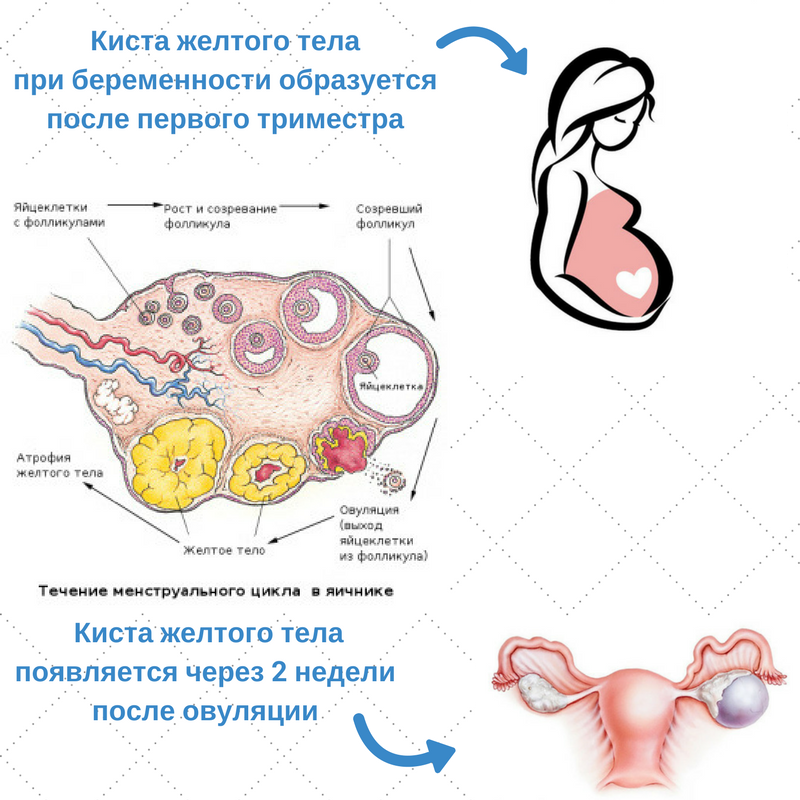 Киста желтого тела при беременности на ранних сроках: симптомы и лечение
