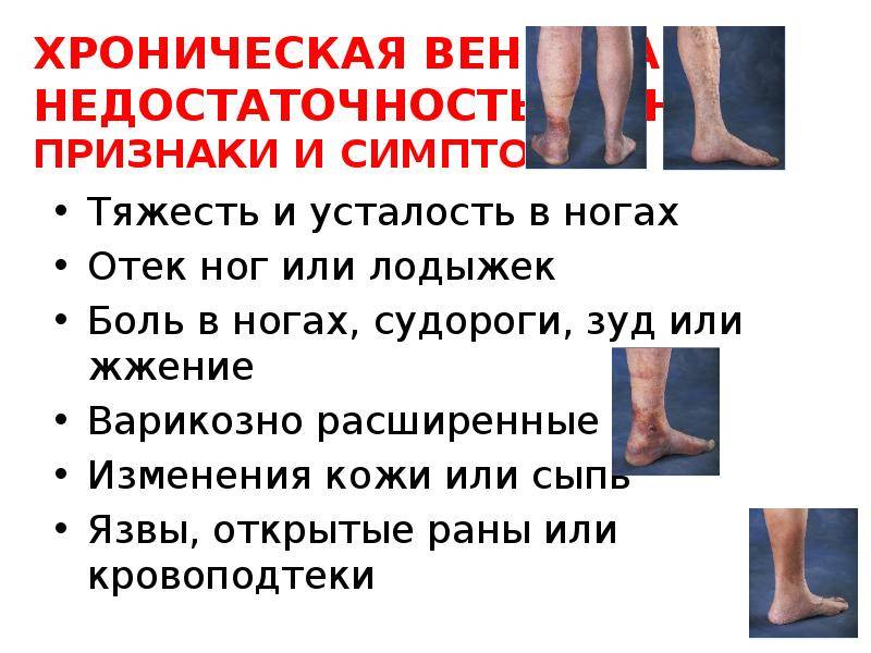 Покалывание в ногах после ходьбы | spinahelp.ru