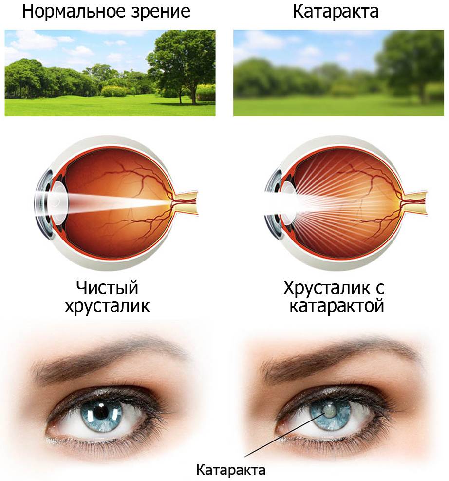 Как вылечить катаракту народными средствами: советы, рецепты - "здоровое око"