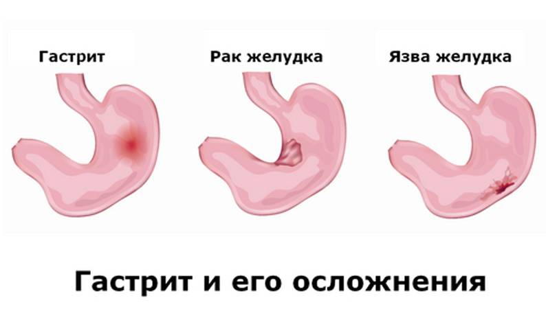 Болит желудок после еды при гастрите. 
что делать при гастрите. luchshijlekar.ru