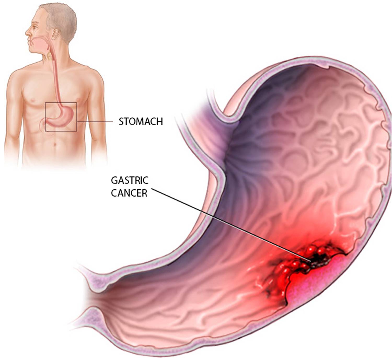 Как проявляется язва симптомы. Малигнизация язвы желудка. Аутоиммунный гастрит на ФГДС. Злокачественная опухоль желудка.