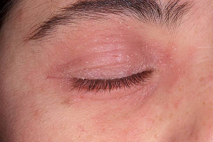 Аллергия под глазами: причины и лечение, мази, фото