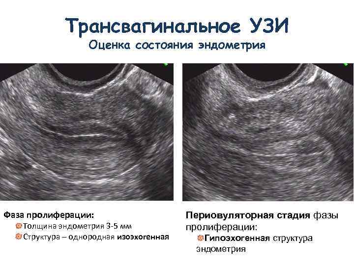 Гипоплазия матки: понятие, лечение, вероятность беременности