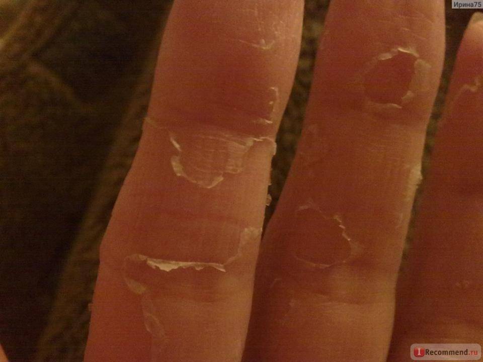 Почему облазит кожа на пальцах рук: причины, методы лечения