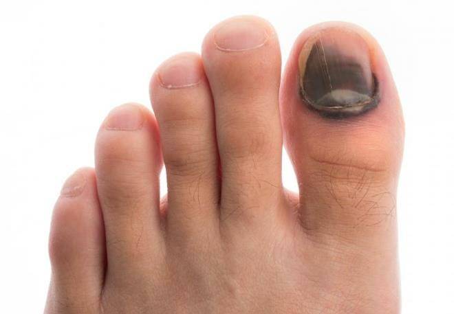 Почему чернеют ногти на ногах у женщин: причины и лечение ногтей - секреты красоты - 2020