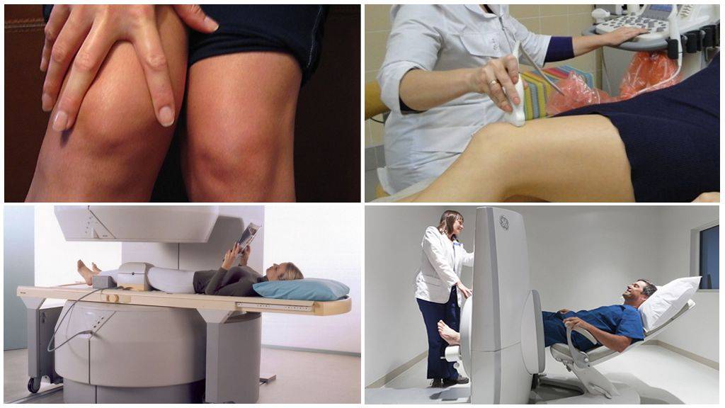 Диагноз доа суставов. Деформирующий остеоартроз коленных суставов клиника. Гонартроз коленного сустава клиника. Гонартроз коленного сустава на УЗИ. Остеоартроз коленного сустава клиника.