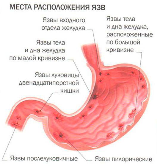 Причины гастрита и язвы желудка