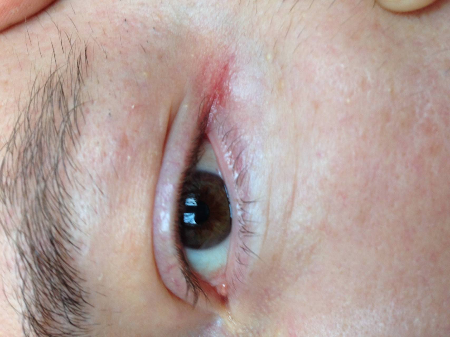 Что делать взрослым, если при аллергии становятся красными глаза?