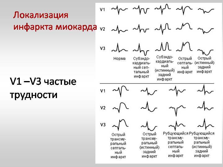 Диагностика и экг при инфаркте миокарда: фото с расшифровкой