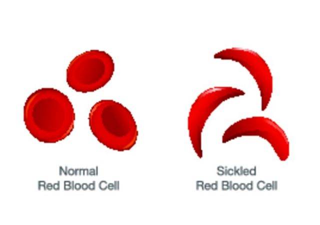 Серповидно-клеточная анемия. причины, симптомы, диагностика и лечение серповидно-клеточной анемии.!