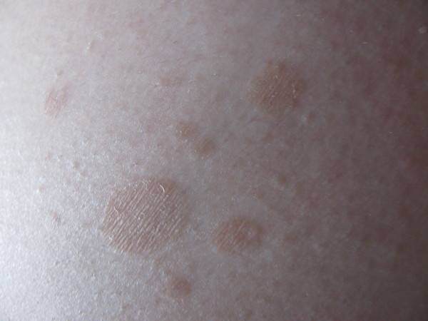 Пятна на коже шелушатся, но не чешутся: причины и лечение