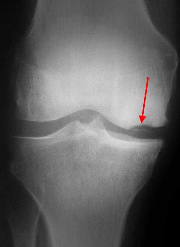 Болезнь кенига коленного сустава операция | лечение суставов