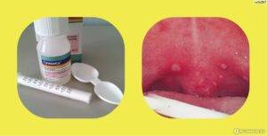 Грибковый тонзиллит: причины, симптомы, фото тонзилломикоза и лечение грибковой ангины у ребенка