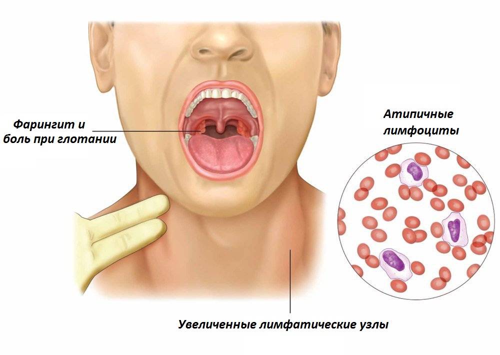 Герпес в горле у ребенка – как лечить герпесную ангину у детей? герпесная ангина у детей – симптомы, фото