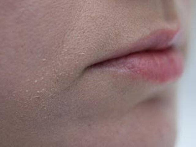 Как устранить сухость кожи вокруг рта?
