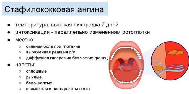 Стафилококк в горле: признаки, как лечить - горлонос.ру