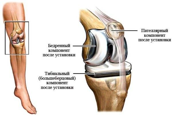 Упражнения бубновского при артрозе коленного сустава
