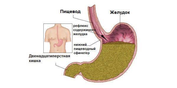 Симптомы и лечение желудочного кашля и как от него избавиться