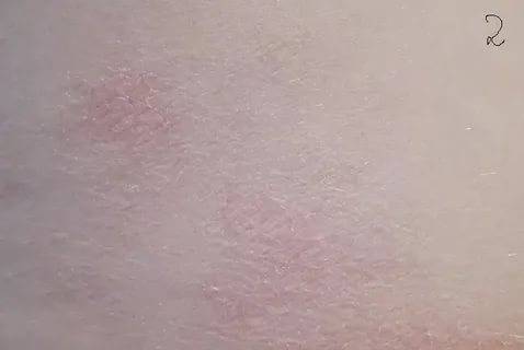 Почему чешется и шелушится кожа лица: причины, лечение препаратами и народными средствами
