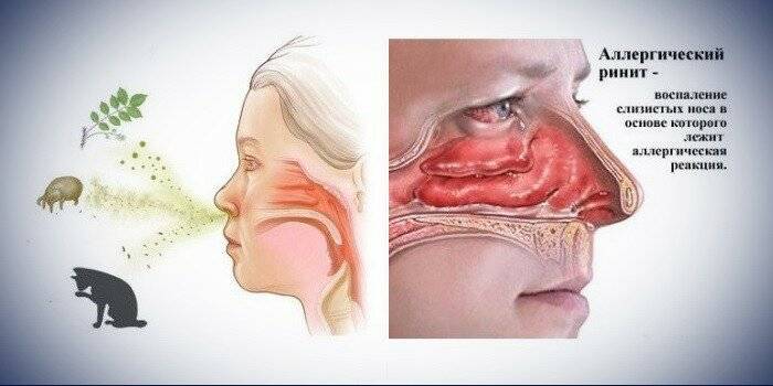 Болячки в носу: как лечить