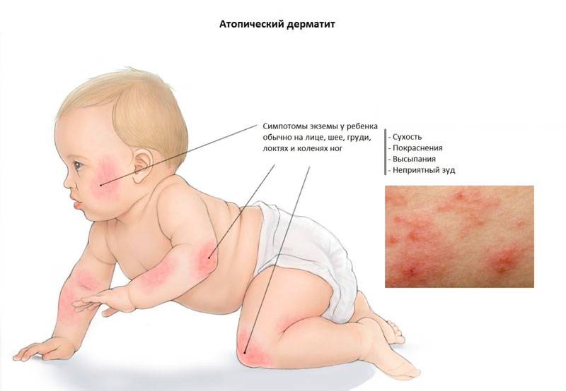Аллергический дерматит у детей:причины, симптомы на фото и лечение