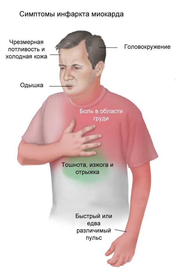 Признаки инфаркта у мужчин старше 60. Ранние симптомы инфаркта миокарда. Инфаркт миокарда симптомы у мужчин. Симптомы инфаркта миока. Сердечный приступ симптомы.