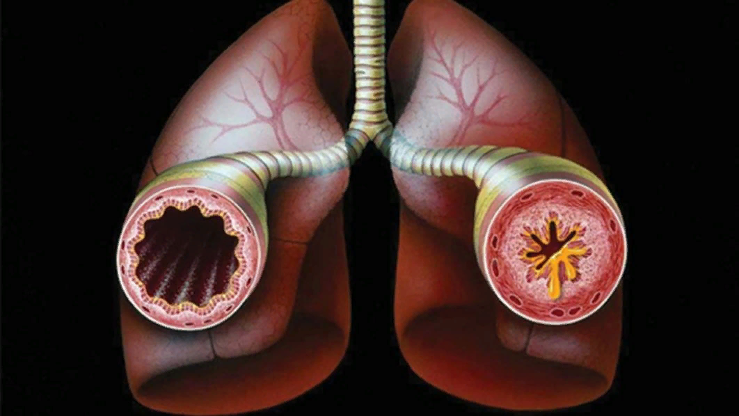 Бронхиальная астма обструкция. Трахеит, бронхит бронхиальная астма. Бронхиальная астма это хроническое заболевание. Осложнения трахеи