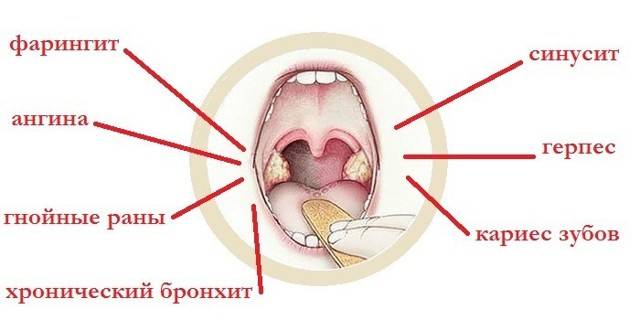 Стафилококк в горле: признаки, как лечить