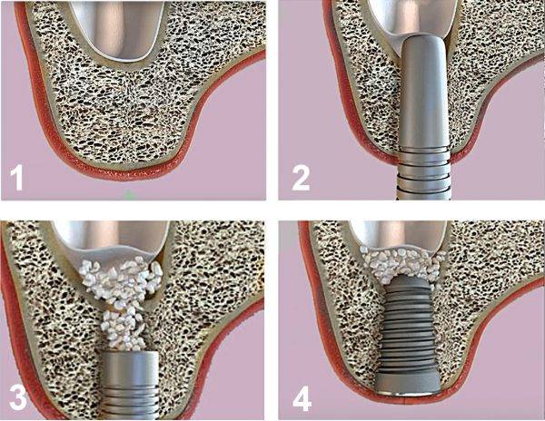 Синус-лифтинг при имплантации зубов. наращивание кости на верхней челюсти