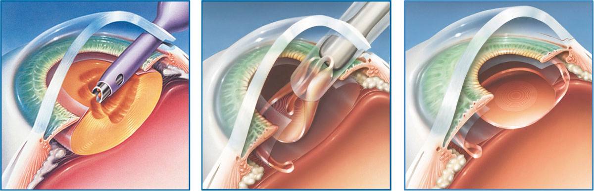 Лечение катаракты без операции народными средствами