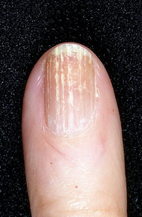 Почему на ногтях появляются чёрные полоски?
