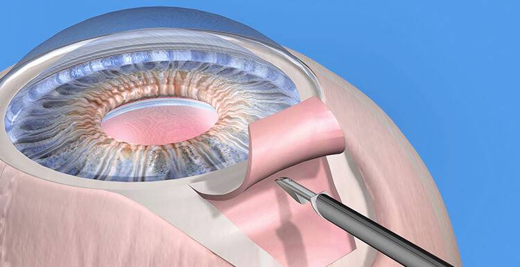 Операция при глаукоме и реабилитационный период