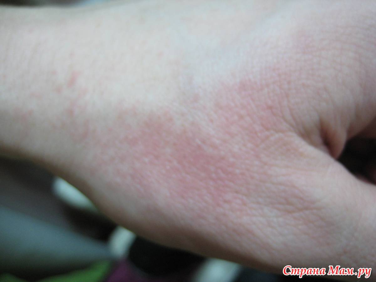 Лечение аллергического дерматита у взрослых