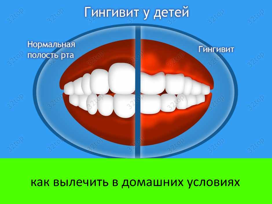 Гингивит: лечение в домашних условиях, симптомы у взрослых и детей | spacream.ru