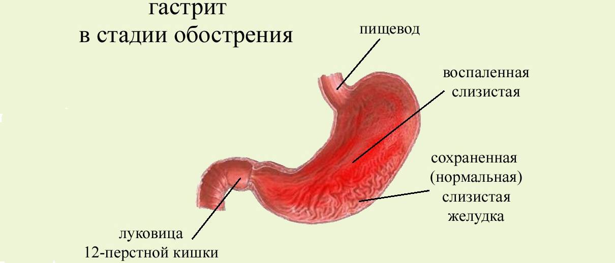 Слизистой оболочки желудка признаки