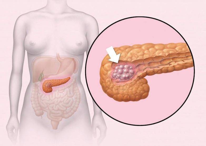 Диффузные изменения поджелудочной железы по типу липоматоза, панкреатита, при фиброзе – что это такое?