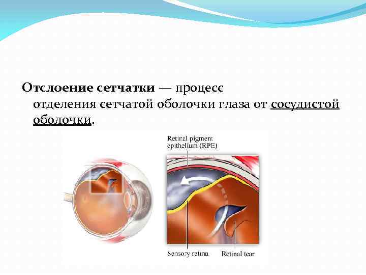 Отслойка сетчатки причины. Первичная и вторичная отслойка сетчатки. Механические факторы отслойки сетчатки. Отслойка сетчатки глаза. Отслойка сетчатки глаза симптомы.
