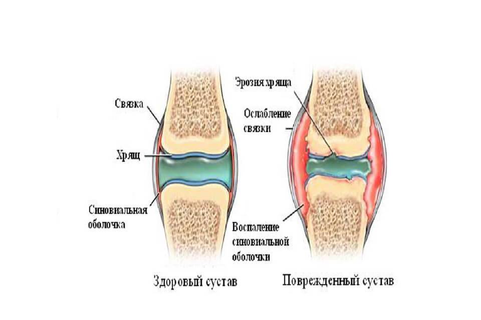 Сильные боли при разгибании колена. Суставной хрящ и синовиальная жидкость. Посттравматический артрит.