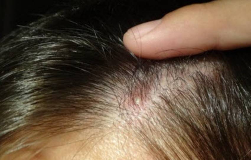 Причины и лечение прыщей на голове в волосах у мужчин и женщин: фото, почему появляются, шампуни и другие средства