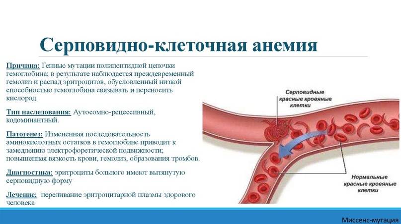 Серповидноклеточная анемия. причины, симптомы, диагностика и лечение патологии :: polismed.com