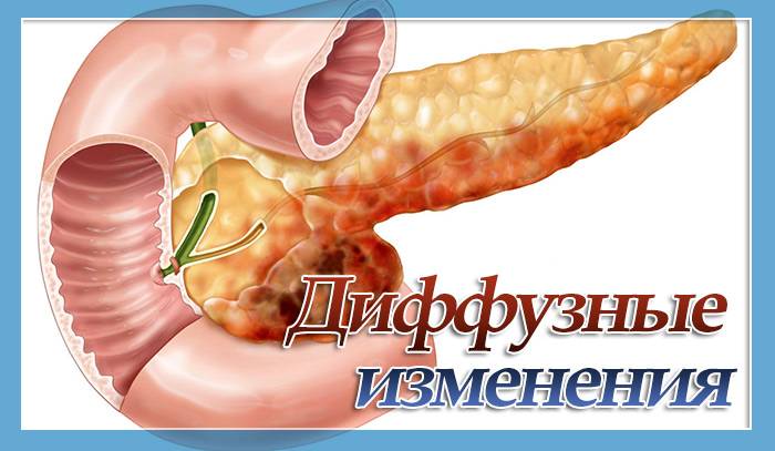 Всё, что вы хотели знать о фибролипоматозе поджелудочной железы