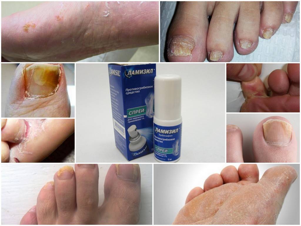 Онихомикоз: фото, лечение ногтей на ногах и руках