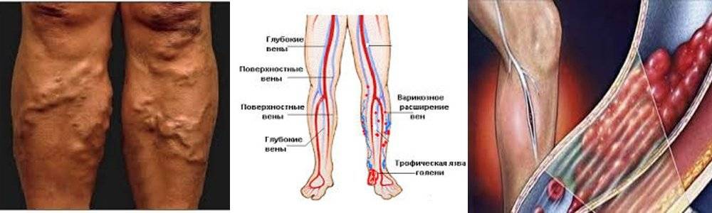 Симптомы, диагностика и лечение тромбофлебита поверхностных вен нижних конечностей