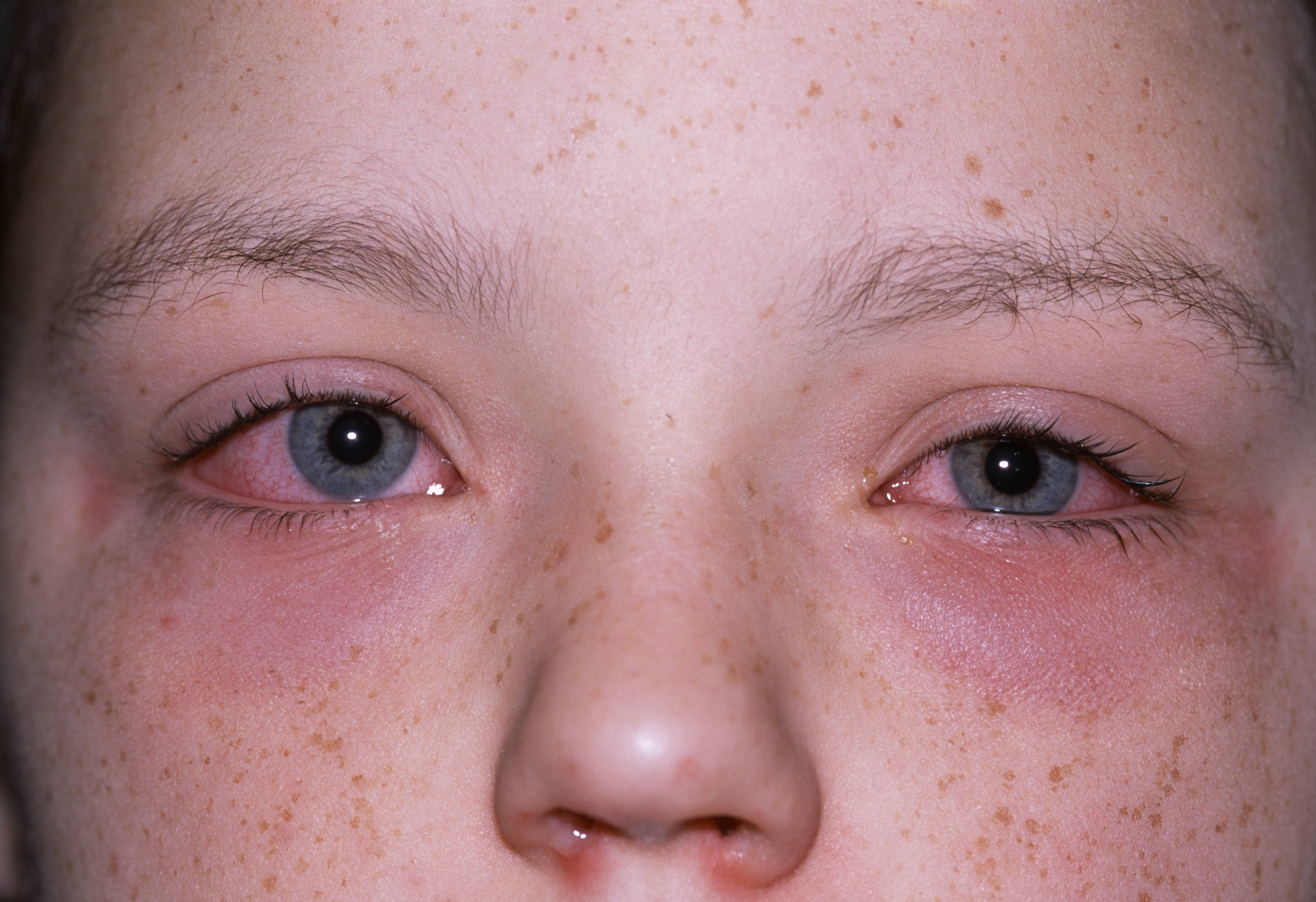 Аллергия на глазах – покраснение глаз у детей и взрослых: причины аллергической реакции, лечение жжения и отечностей
