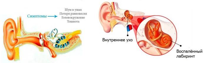 Болезнь внутреннего уха. Воспаление среднего уха (лабиринтит);. Воспалительные заболевания внутреннего уха (лабиринтиты).. Воспаление внутреннего уха лабиринтит. Внутренний отит (лабиринтит).